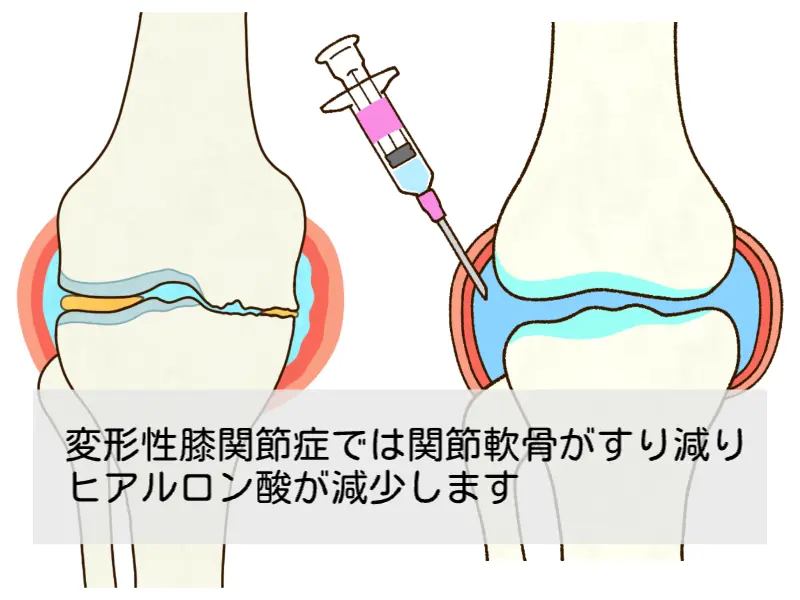 変形性膝関節症 膝関節 構造 ヒアルロン酸